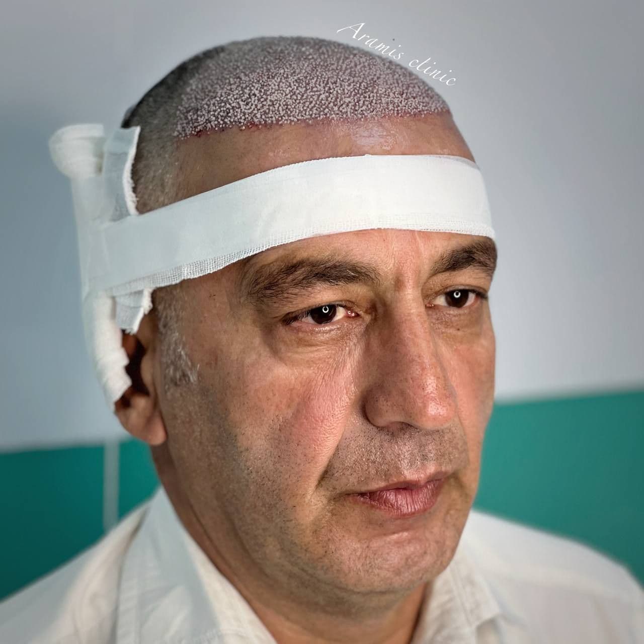 کاشت مو