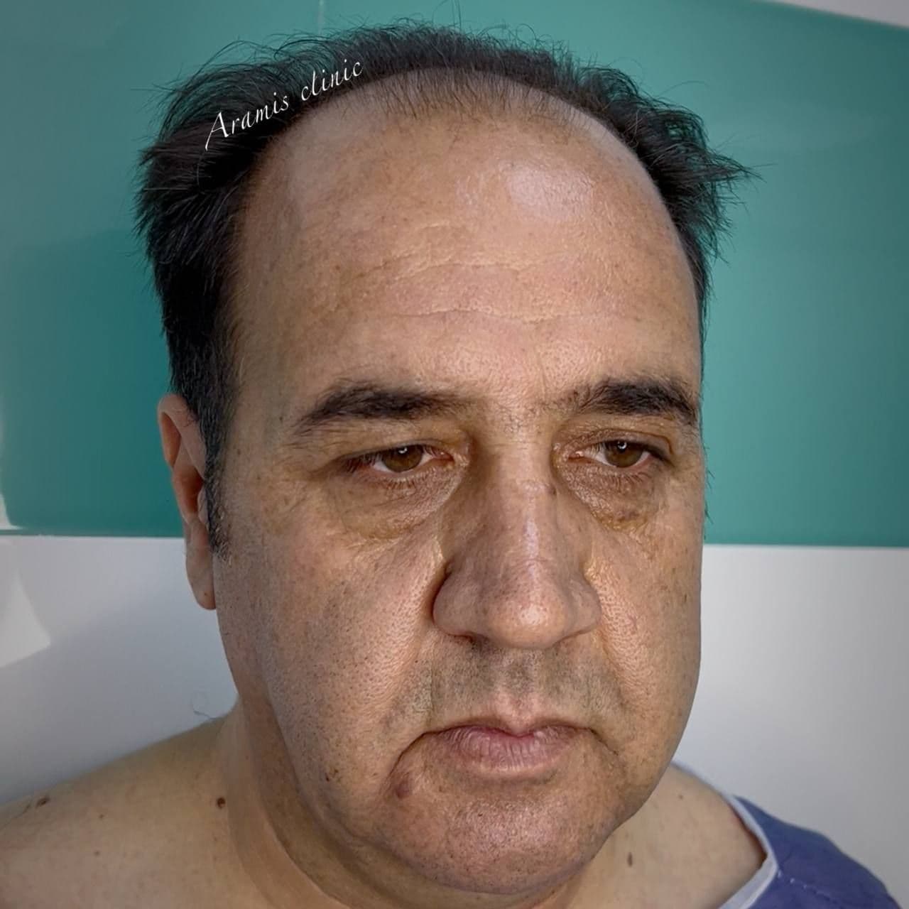 قبل - 1