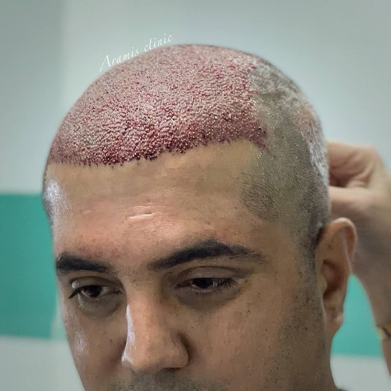 کاشت مو